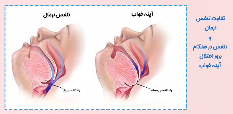 تفاوت تنفس نرمال و آپنه خواب