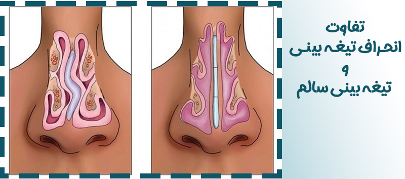 تفاوت انحراف بینی و تیغه بینی سالم
