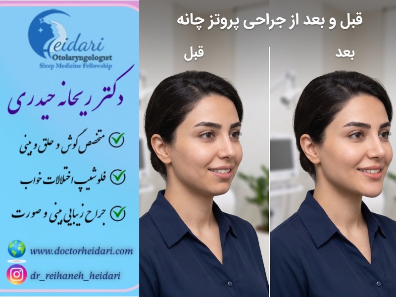 عکس جراحی پروتز چانه