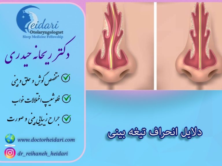 دلایل انحراف بینی دلایل انحراف بینی