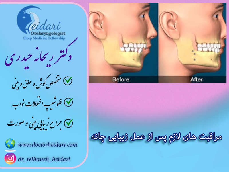 مراقبت های لازم پس از عمل زیبایی چانه