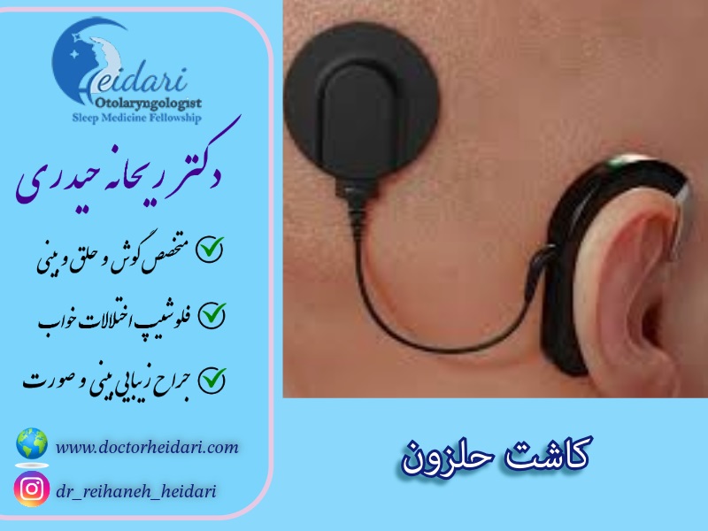 کاشت حلزون