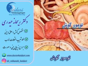تومور گوش