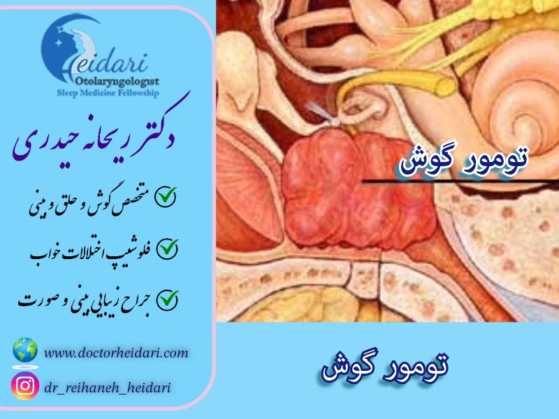 تومور گوش